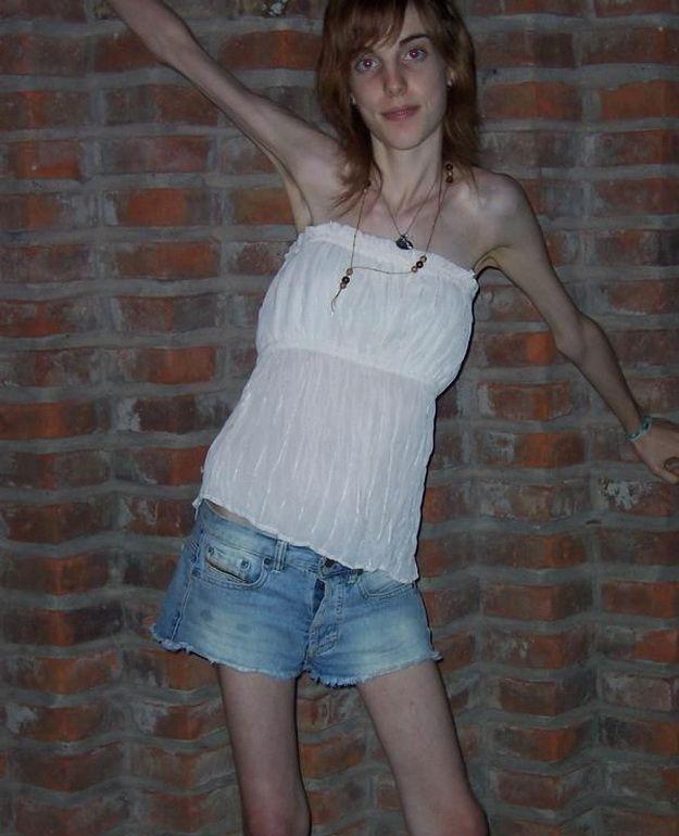 Anorexia3.jpg