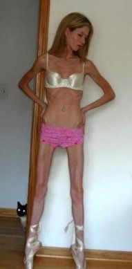 Anorexia6.jpg