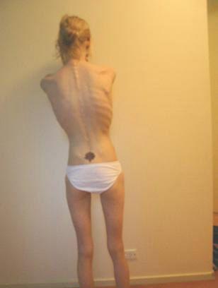 Anorexia7.jpg